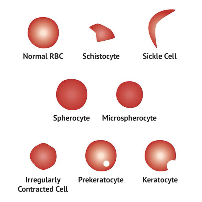 Blood Film Interpretation